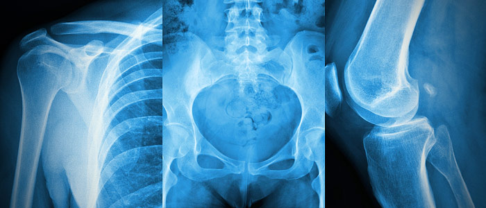 Bone and Joint initiative gets ‘leg up’ from NSERC funding