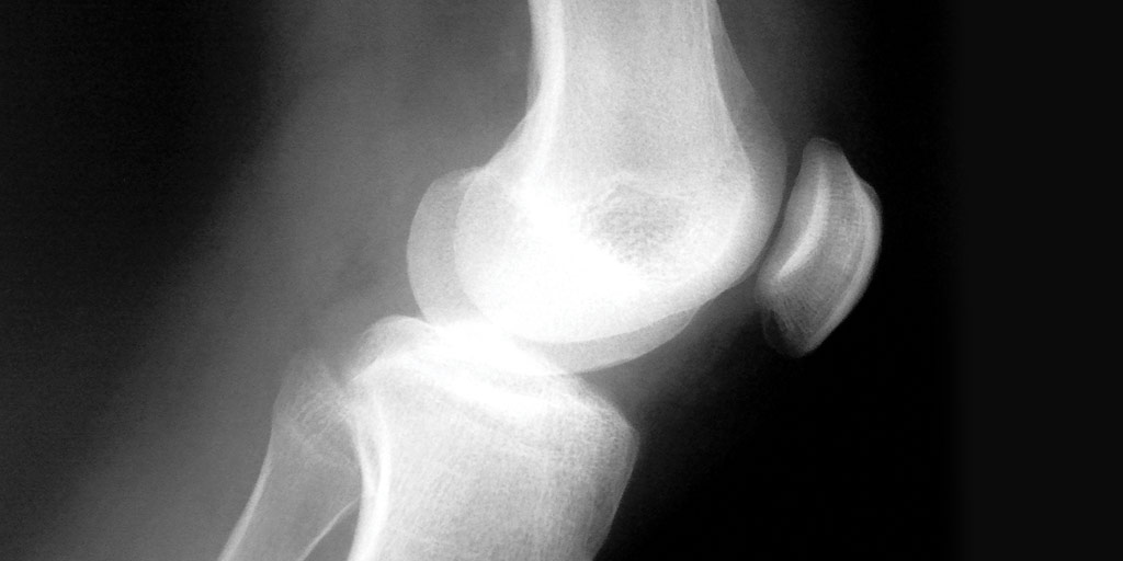 New Western study suggests arthroscopic knee surgery not cost-effective compared to other ‘non-operative’ treatments