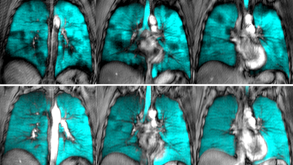 Using lung MRI to see where and why Canadians with asthma have poor disease control