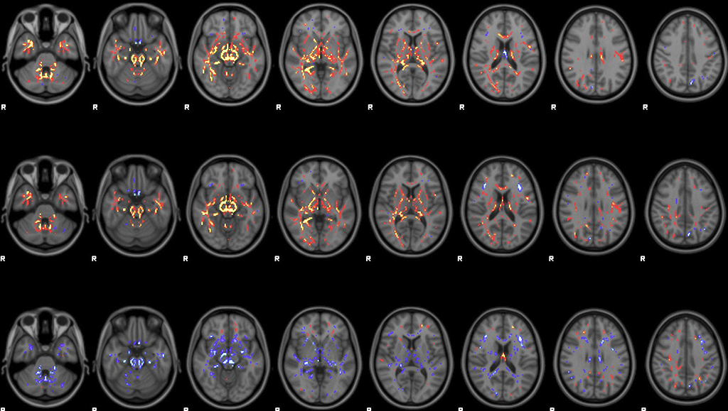 MRI technique shows unique signatures of concussion in rugby players