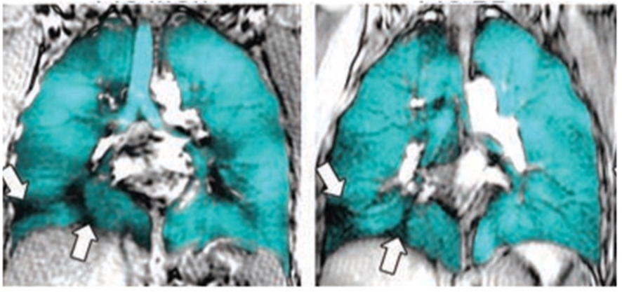 Lung images taken through MRI that show in turquoise where there is airflow in the lungs