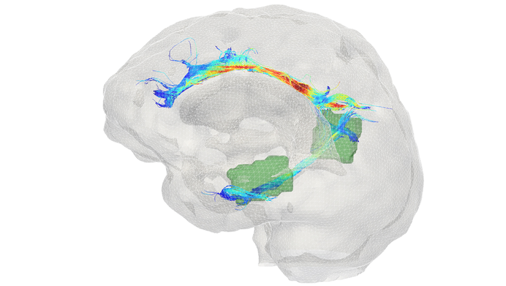 Research points to early detection for Alzheimer’s disease