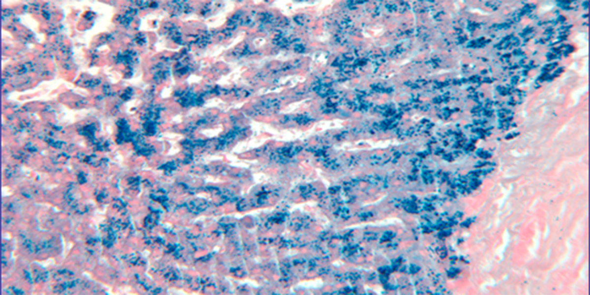 Liver cancer ten times more likely in men with common genetic disorder haemochromatosis