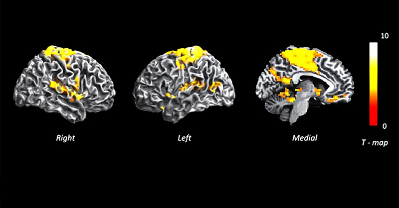Study pinpoints role of language disruptions in psychosis