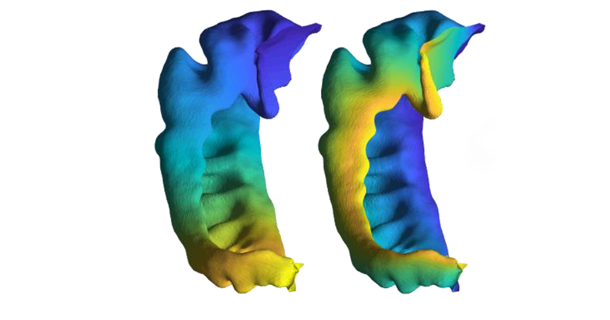 Western-developed technique digitally irons out brain wrinkles for accurate insight on brain disorders