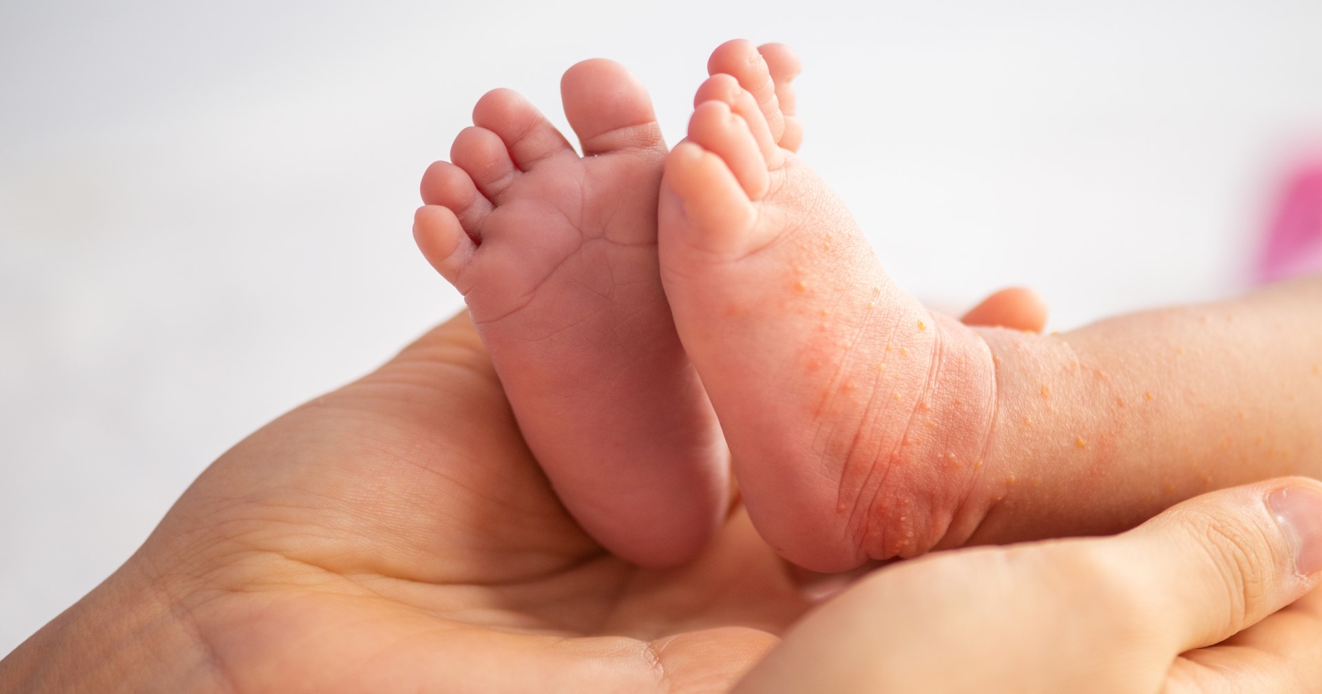 Expert insight: The resurgent threat of measles in Canada