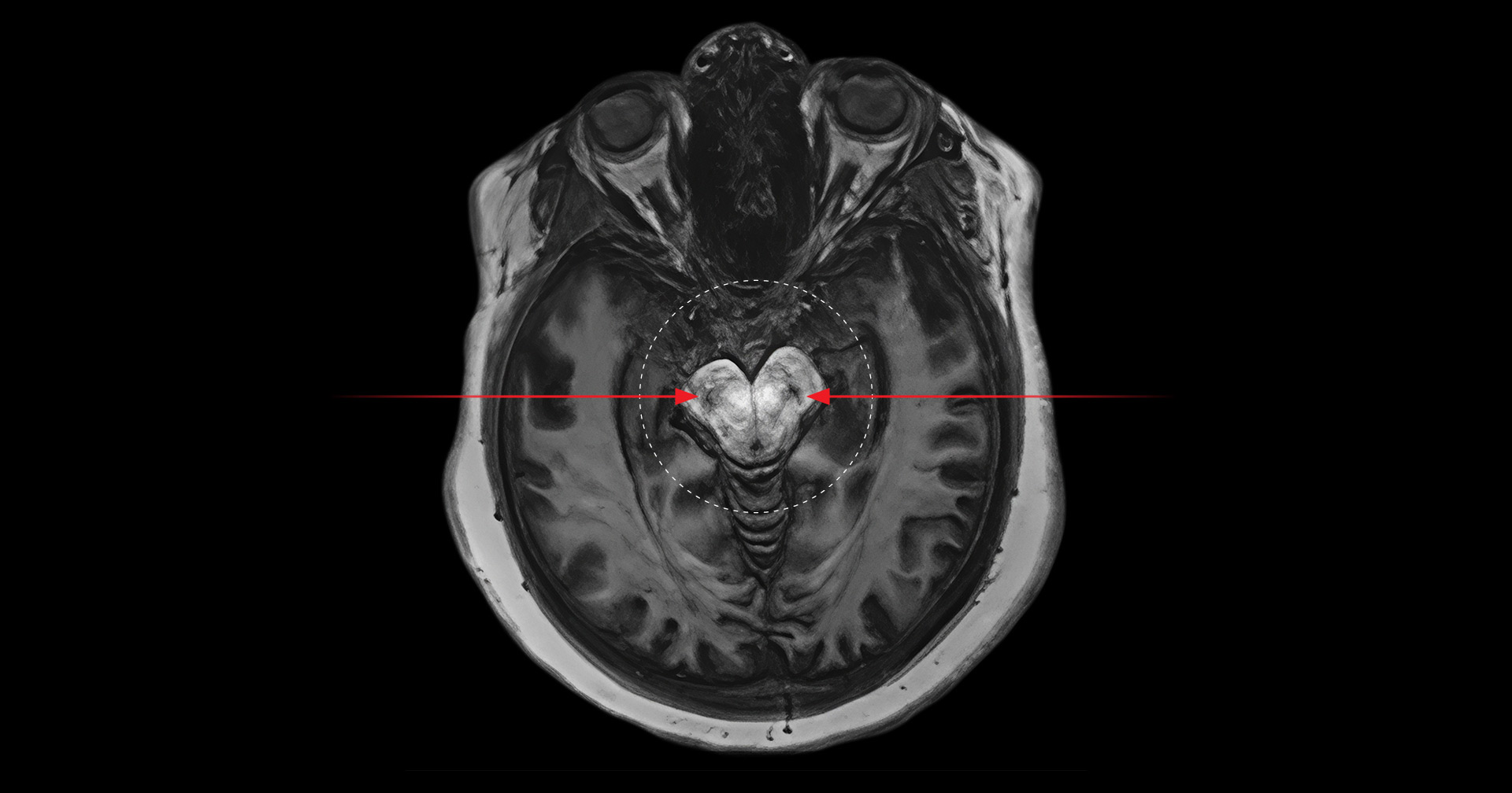 New study reveals potential biological link between cannabis and psychosis