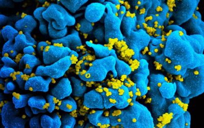 A Toronto man could become the 1st Canadian cured of HIV thanks to rare bone marrow treatment | CBC As it Happens